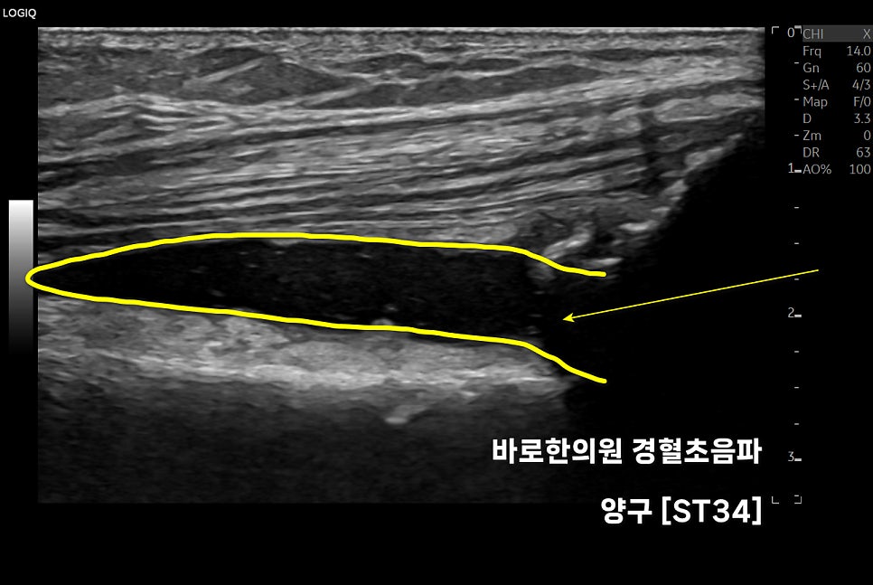 초음파 이미지에서 노란색 선으로 표시된 대퇴직근 주변의 액체 저류 — 초음파 정밀 진단 | 서울 바로한의원 초음파 약침·도침·침도