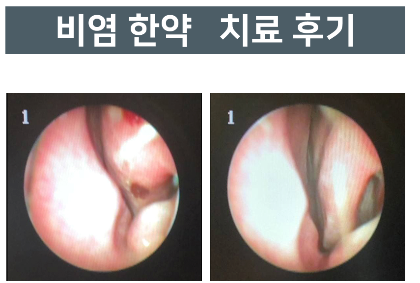 비염 한약 치료 전후 코 내부를 촬영한 내시경 사진 — 서울 바로한의원 초음파 약침·도침