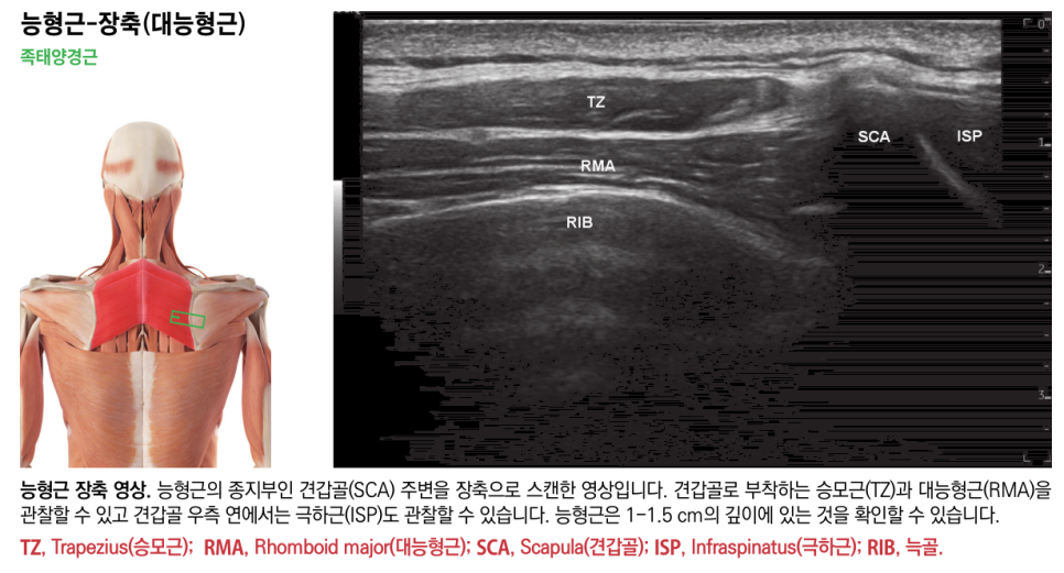 능형근의 해부학적 위치를 보여주는 인체 그림과 능형근, 승모근, 견갑골, 극하근, 늑골이 표시된 장축 초음파 영상 — 초음파 정밀 진단 | 서울 바로한의원 초음파 약침·도침·침도