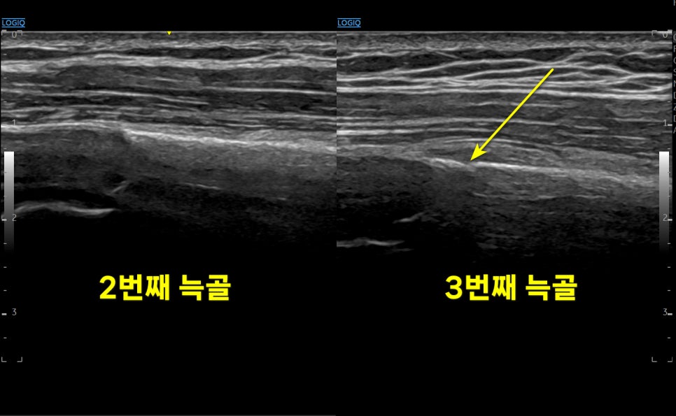 2번 늑골과 3번 늑골의 초음파 영상으로, 3번 늑골 부위에 노란색 화살표가 표시되어 있다 — 초음파 정밀 진단 | 서울 바로한의원 초음파 약침·도침·침도