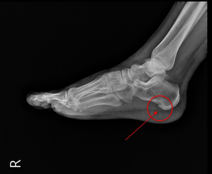 오른쪽 발 X-ray 사진으로, 발뒤꿈치뼈에 뼈 돌기가 빨간 원과 화살표로 표시되어 있습니다 — 서울 바로한의원 초음파 약침·도침