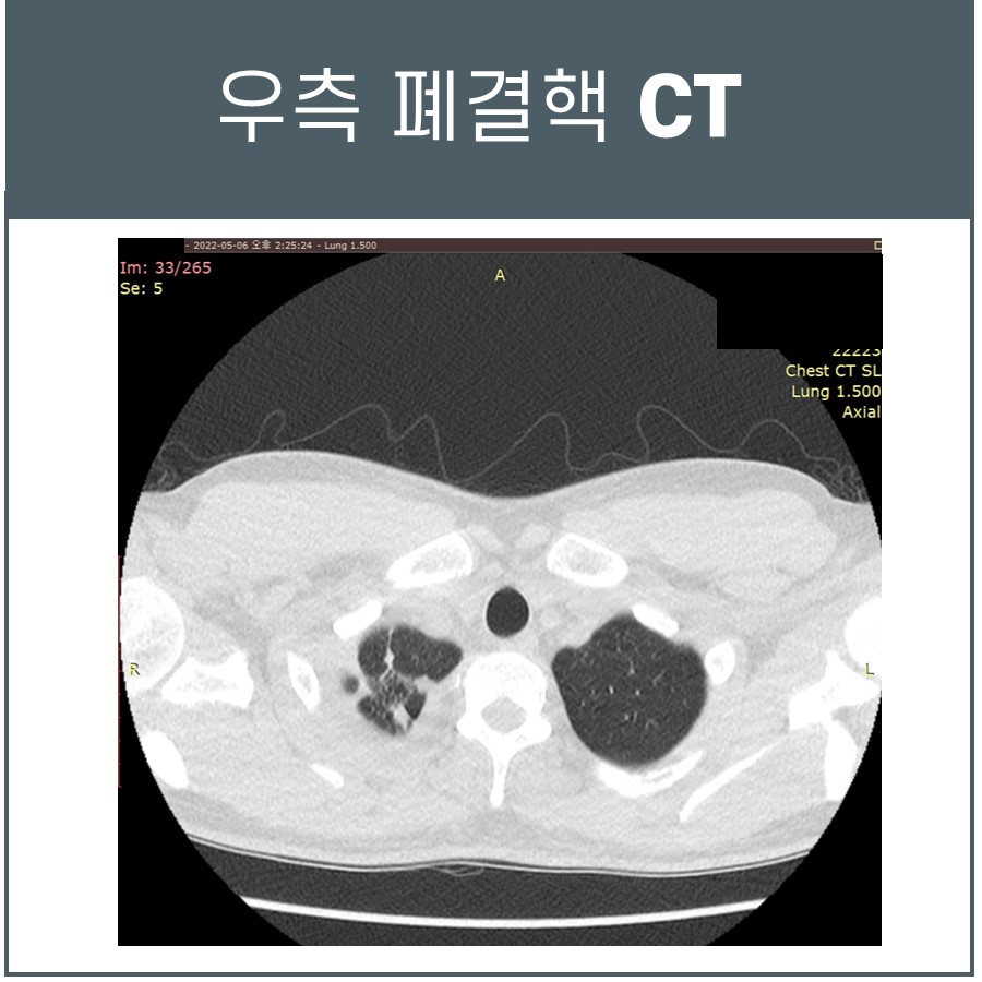 우측 폐결핵이 보이는 흉부 CT 영상 — 서울 바로한의원 초음파 약침·도침
