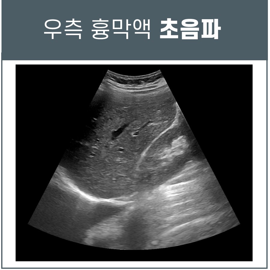 우측 흉막액 초음파 검사 이미지 — 초음파 정밀 진단 | 서울 바로한의원 초음파 약침·도침·침도