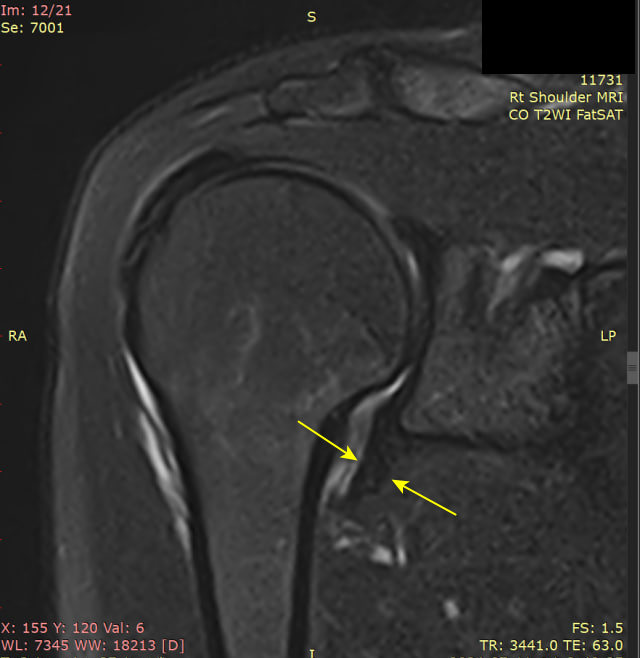 오른쪽 어깨 MRI 영상에서 노란색 화살표가 어깨 관절 주변의 염증 소견을 나타냅니다 — 서울 바로한의원 초음파 약침·도침