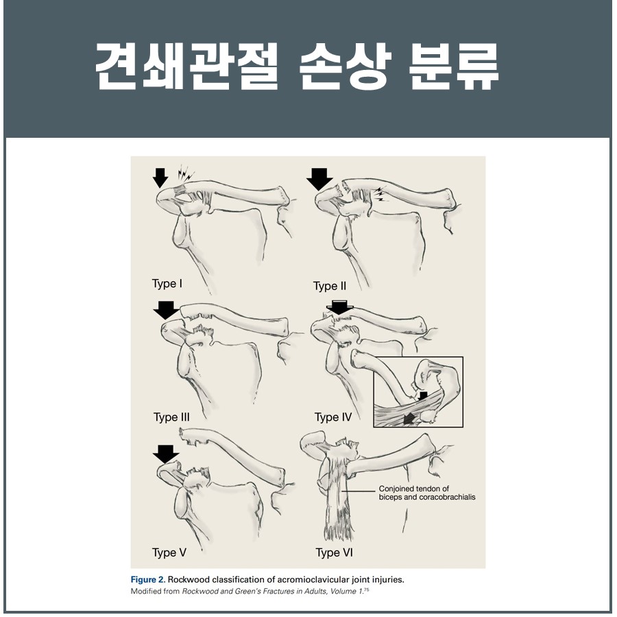 견쇄관절 손상을 6가지 유형으로 분류한 그림 — 서울 바로한의원 초음파 약침·도침
