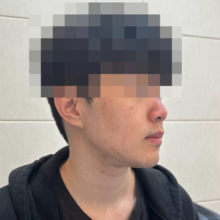 얼굴 옆모습에 코와 뺨에 붉은 기가 보이는 남성 — 서울 바로한의원 초음파 약침·도침