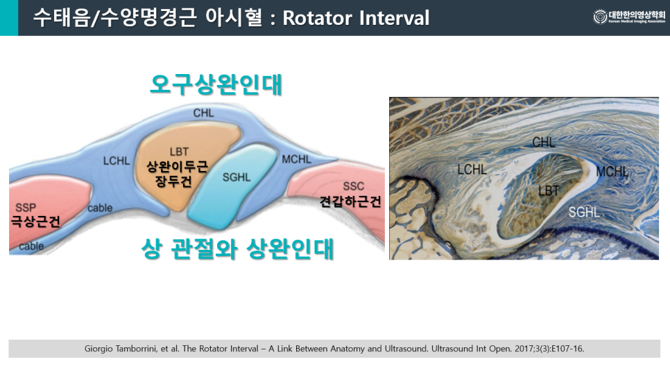 어깨 회전근개 간격의 해부학적 구조를 보여주는 도식과 조직 사진 — 서울 바로한의원 초음파 약침·도침