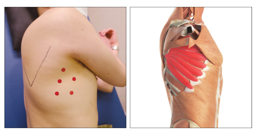 옆구리에 표시된 붉은 점과 톱니근(serratus anterior muscle) 해부학적 그림 — 서울 바로한의원 초음파 약침·도침