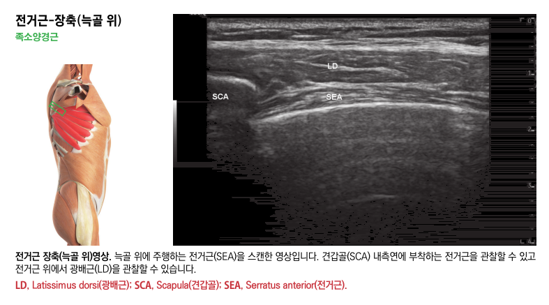 전거근 해부학 그림과 전거근, 광배근, 견갑골을 보여주는 초음파 영상 — 초음파 정밀 진단 | 서울 바로한의원 초음파 약침·도침·침도