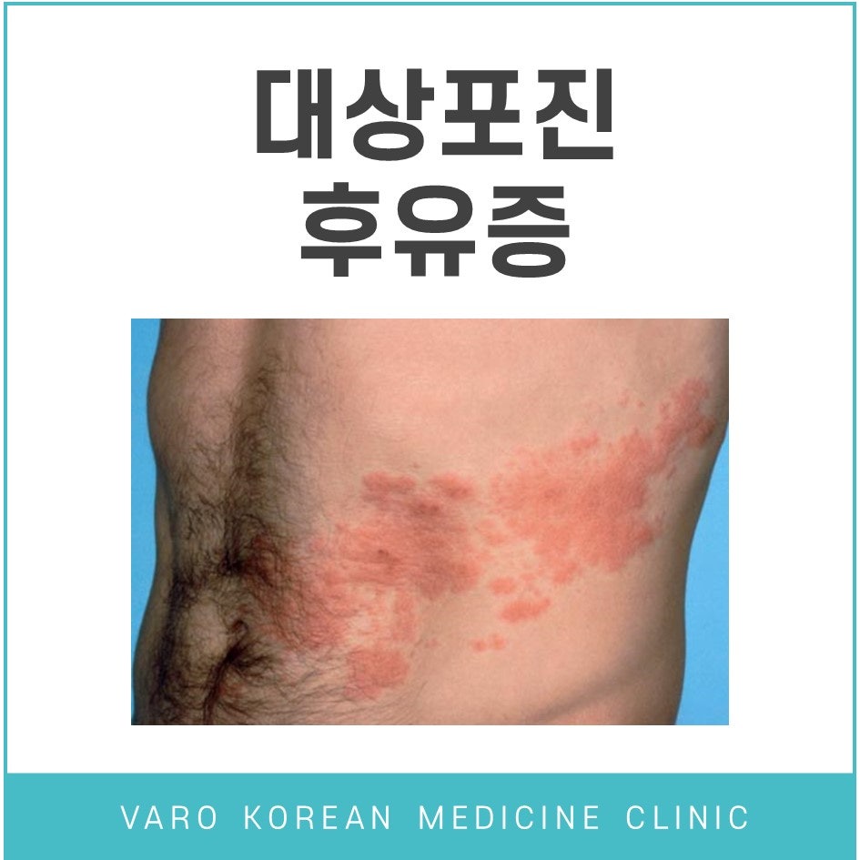 한 남성의 옆구리에 붉은 발진이 넓게 퍼져 있는 모습 — 서울 바로한의원 초음파 약침·도침