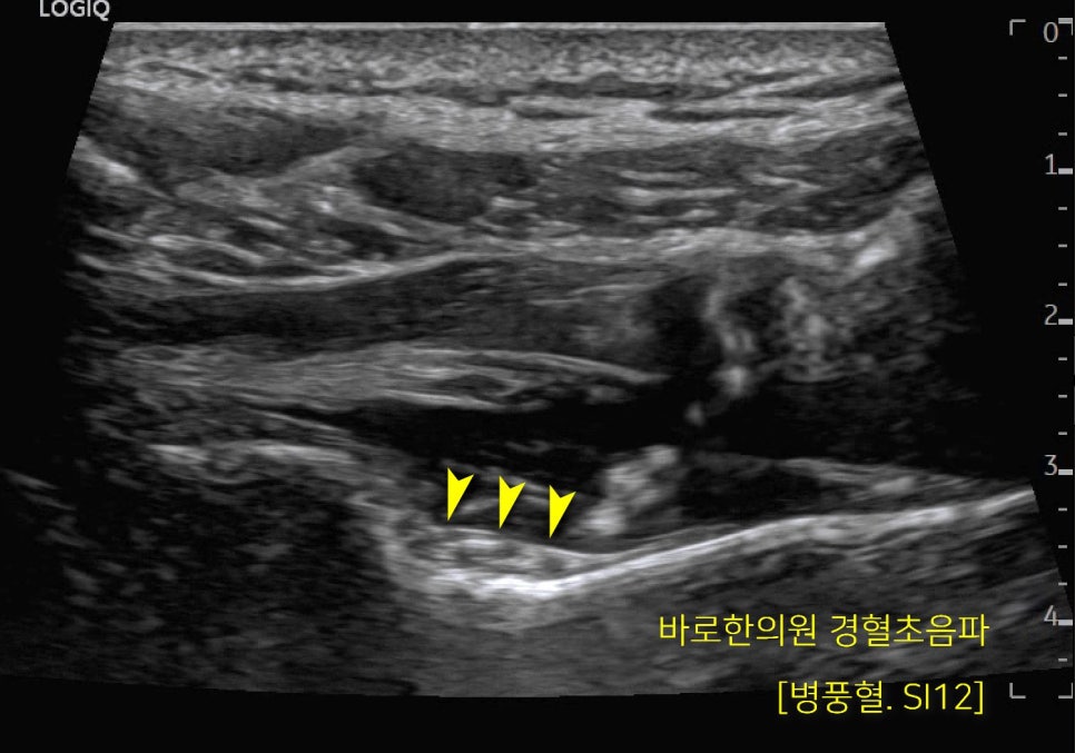어깨 부위 경혈 SI12(병풍혈)의 초음파 사진입니다 — 초음파 정밀 진단 | 서울 바로한의원 초음파 약침·도침·침도