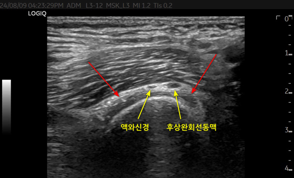 어깨 부위의 액와신경과 후상완회선동맥을 보여주는 초음파 사진 — 초음파 정밀 진단 | 서울 바로한의원 초음파 약침·도침·침도