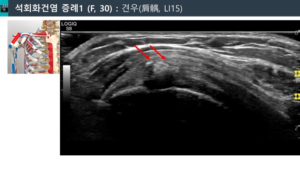 어깨 힘줄에 석회 침착물이 붉은 화살표로 표시된 초음파 사진과 어깨 관절 해부학 모형 — 초음파 정밀 진단 | 서울 바로한의원 초음파 약침·도침·침도
