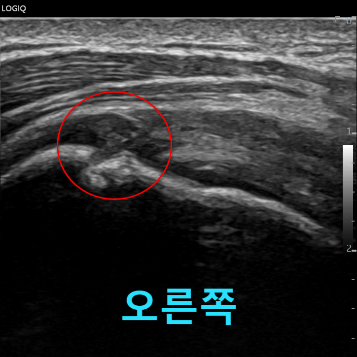 어깨 앞쪽을 촬영한 초음파 사진으로, 빨간색 원 안에 특정 부위가 표시되어 있고 하단에 '오른쪽'이라는 글자가 있다 — 초음파 정밀 진단 | 서울 바로한의원 초음파 약침·도침·침도