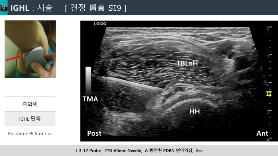 어깨에 초음파 탐촉자를 대고 바늘을 삽입하는 초음파 영상과 시술 사진 — 초음파 유도하 약침 시술 | 서울 바로한의원