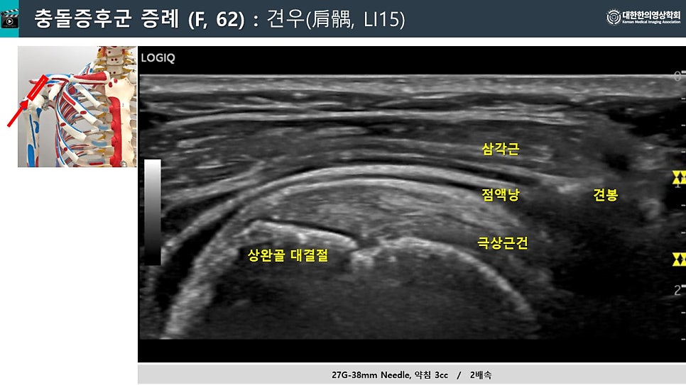 어깨충돌증후군 해부학적 그림과 어깨 초음파 영상으로 삼각근, 견봉, 점액낭, 극상건, 상완골 대결절이 표시되어 있습니다 — 초음파 정밀 진단 | 서울 바로한의원 초음파 약침·도침·침도