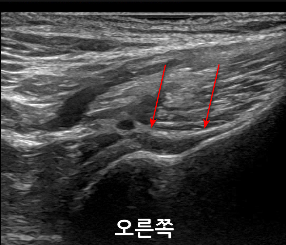 어깨 초음파 사진에서 빨간 화살표가 어깨 부위의 특정 조직을 가리키고 있다 — 초음파 정밀 진단 | 서울 바로한의원 초음파 약침·도침·침도