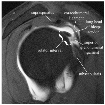 어깨 관절 MRI 영상으로, 회전근개 간격과 주변 인대, 힘줄 등 해부학적 구조가 표시되어 있습니다 — 서울 바로한의원 초음파 약침·도침