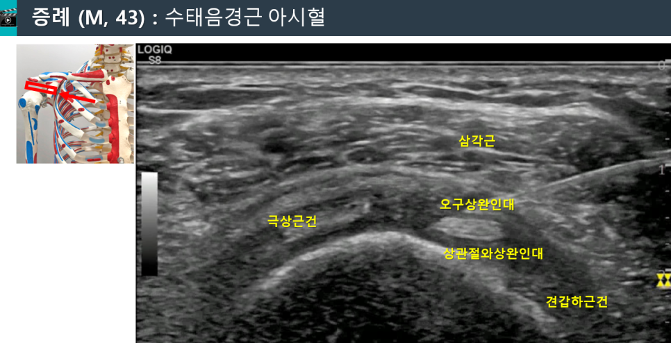 어깨 관절의 삼각근, 극상근건 등이 표시된 초음파 영상과 어깨 해부학 모형 — 초음파 정밀 진단 | 서울 바로한의원 초음파 약침·도침·침도