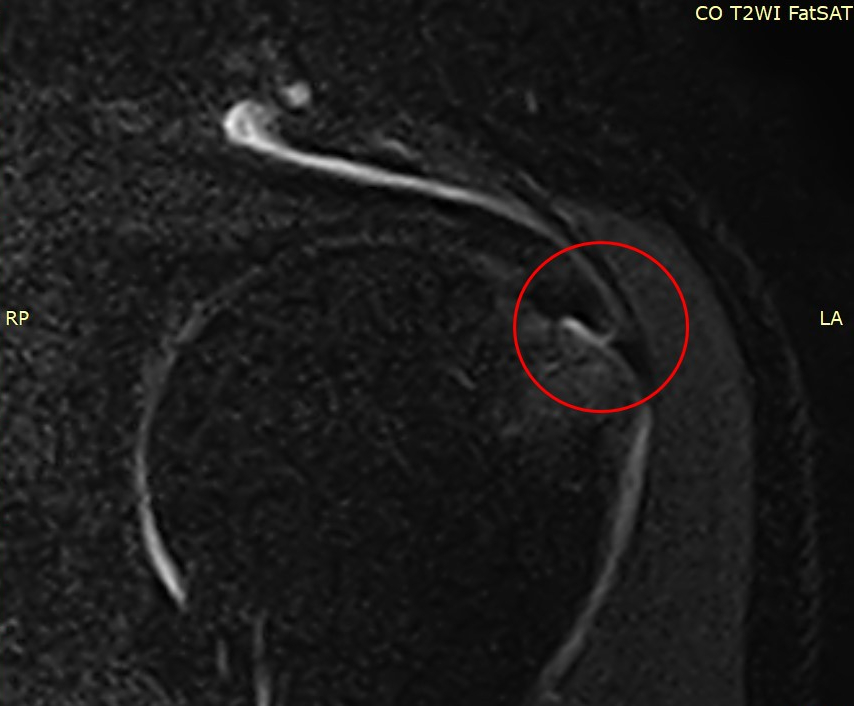 어깨 MRI 영상에 빨간색 원으로 특정 부위가 표시되어 있다 — 서울 바로한의원 초음파 약침·도침