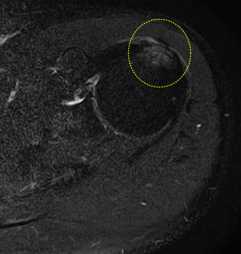 어깨 관절의 자기공명영상(MRI)으로, 노란색 점선 원이 특정 부위를 강조하고 있다 — 서울 바로한의원 초음파 약침·도침