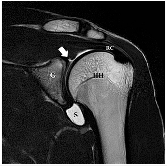 어깨 관절의 MRI 영상으로, 화살표가 관절와순 상부를 가리키고 있다 — 서울 바로한의원 초음파 약침·도침