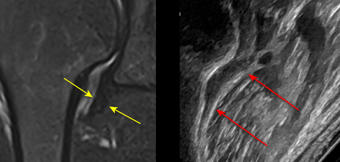 어깨 관절의 MRI 영상과 초음파 영상이 나란히 비교되어 있으며, 각 영상에 화살표로 특정 부위가 표시되어 있다 — 초음파 정밀 진단 | 서울 바로한의원 초음파 약침·도침·침도