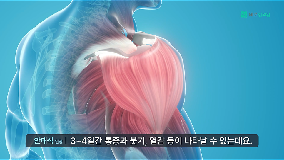 3D 인체 모형으로 어깨와 팔 근육을 보여주는 이미지 — 서울 바로한의원 초음파 약침·도침