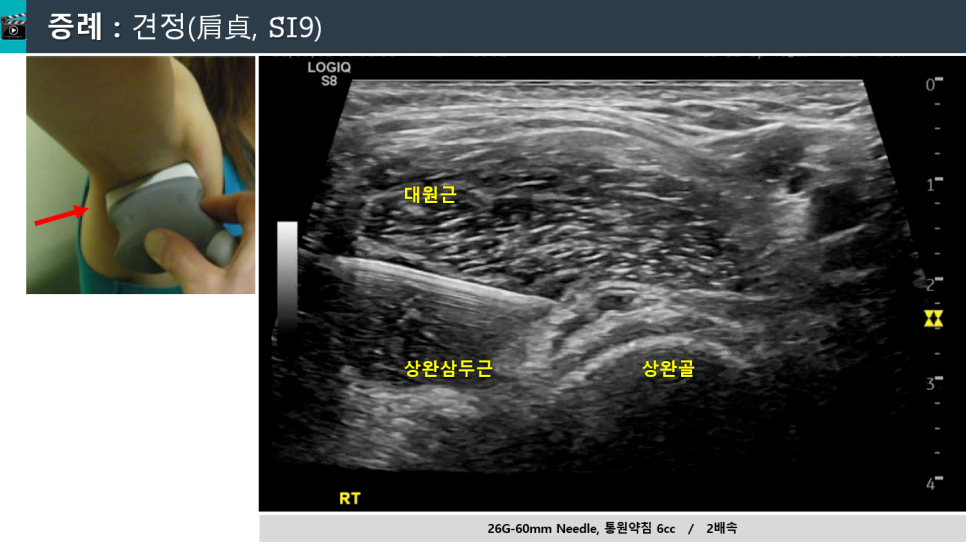 어깨 부위에 초음파 탐촉자를 대고 초음파 영상으로 대원근, 상완삼두근, 상완골 주변에 바늘이 삽입된 모습을 보여주는 사진 — 초음파 유도하 약침 시술 | 서울 바로한의원
