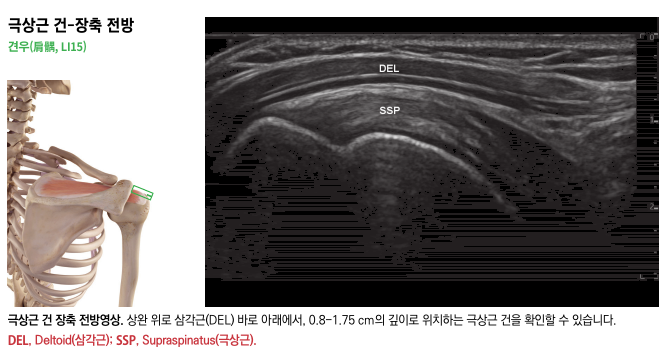 어깨뼈와 팔뼈가 보이는 어깨 해부학 그림과 어깨 삼각근(DEL) 및 극상근(SSP)이 표시된 초음파 영상 — 초음파 정밀 진단 | 서울 바로한의원 초음파 약침·도침·침도