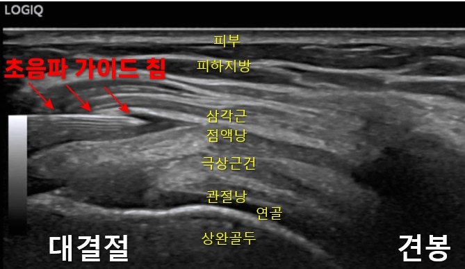 어깨 초음파 영상으로, 초음파 유도 하에 삽입된 침과 주변 해부학적 구조(피부, 피하지방, 삼각근, 점액낭, 극상건, 관절낭, 연골, 상완골두, 대결절, 견봉)가 표시되어 있습니다 — 초음파 유도하 약침 시술 | 서울 바로한의원