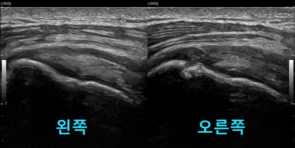 어깨 부위의 왼쪽과 오른쪽 초음파 영상이 나란히 있는 사진 — 초음파 정밀 진단 | 서울 바로한의원 초음파 약침·도침·침도