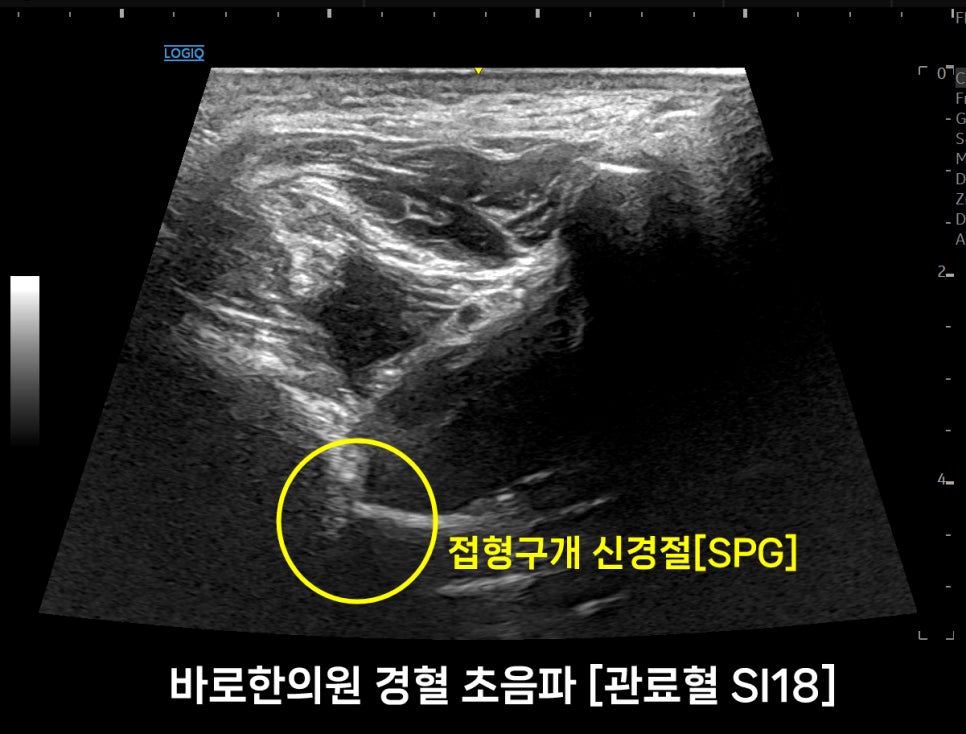 관료혈(SI18) 부위의 접형구개 신경절(SPG)을 보여주는 초음파 이미지 — 초음파 정밀 진단 | 서울 바로한의원 초음파 약침·도침·침도