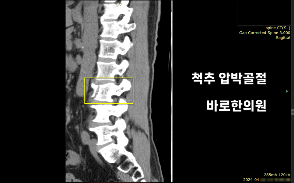 척추 압박골절이 보이는 척추 CT 영상 — 서울 바로한의원 초음파 약침·도침