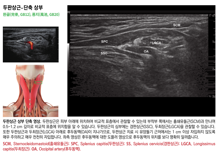목 부위의 두판상근 해부학적 그림과 함께 두판상근, 경판상근, 후두동맥을 보여주는 초음파 영상들이 포함된 이미지 — 초음파 정밀 진단 | 서울 바로한의원 초음파 약침·도침·침도