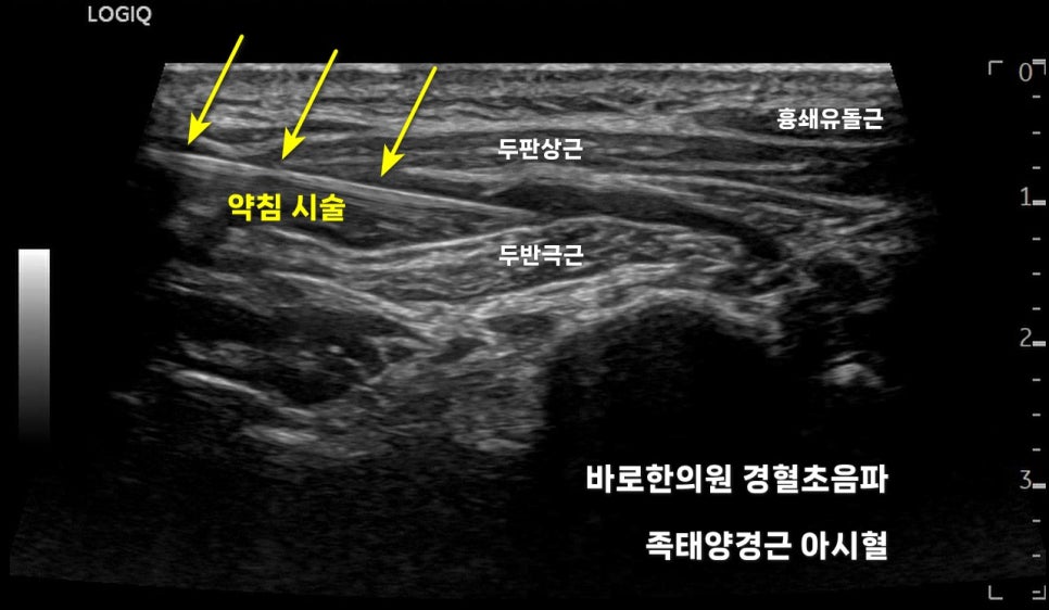 두판상근과 두반극근에 약침 시술이 진행되는 경혈 초음파 사진 — 초음파 유도하 약침 시술 | 서울 바로한의원