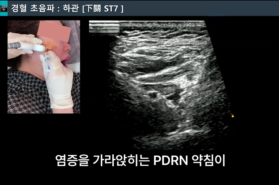 얼굴에 초음파 가이드 약침 시술을 하는 모습과 초음파 화면 — 초음파 유도하 약침 시술 | 서울 바로한의원