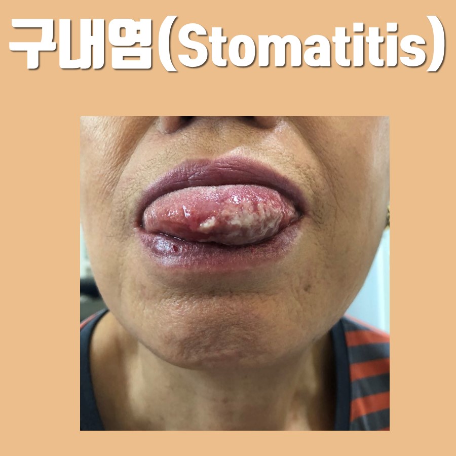 혀에 하얗고 염증이 있는 구내염이 발생한 입술과 혀의 클로즈업 사진 — 서울 바로한의원 초음파 약침·도침