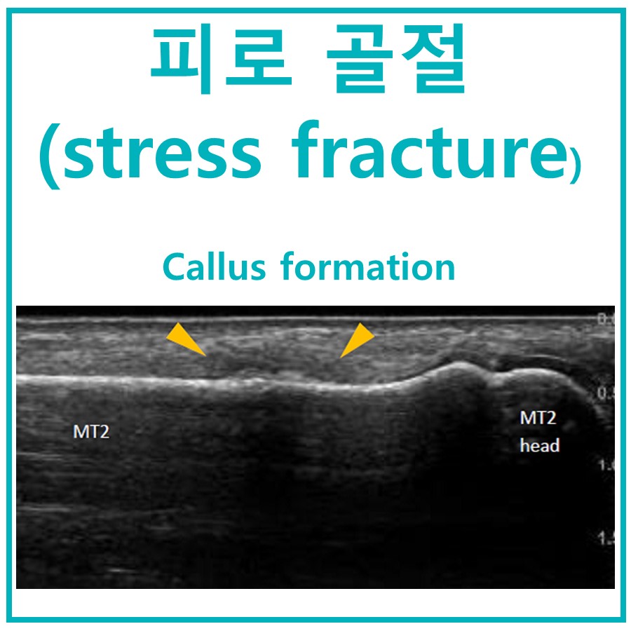 피로 골절로 인한 가골 형성 초음파 사진 — 초음파 정밀 진단 | 서울 바로한의원 초음파 약침·도침·침도