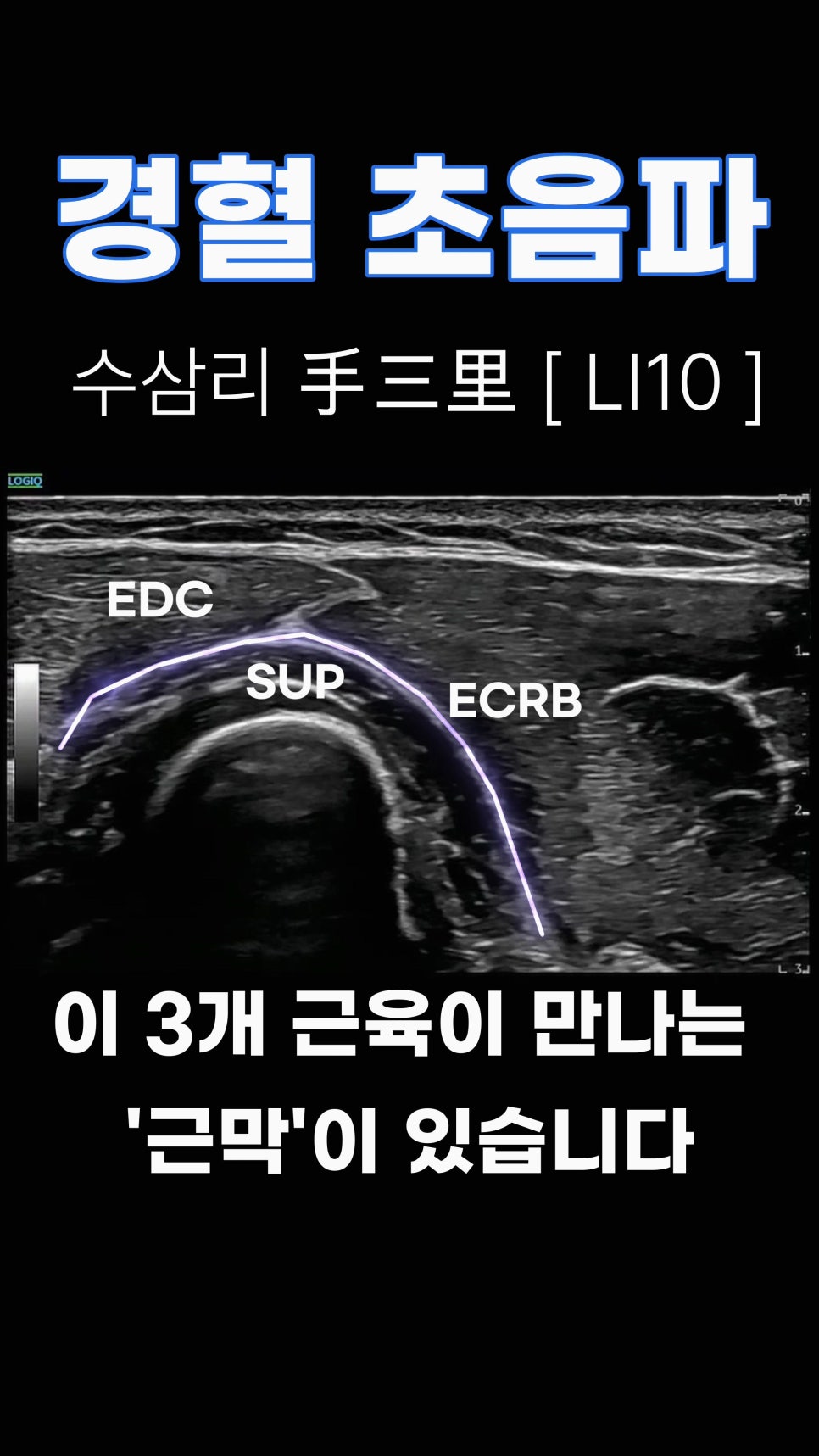 수삼리(LI10) 혈자리 주변의 EDC, SUP, ECRB 근육과 근막을 보여주는 초음파 영상 — 초음파 정밀 진단 | 서울 바로한의원 초음파 약침·도침·침도