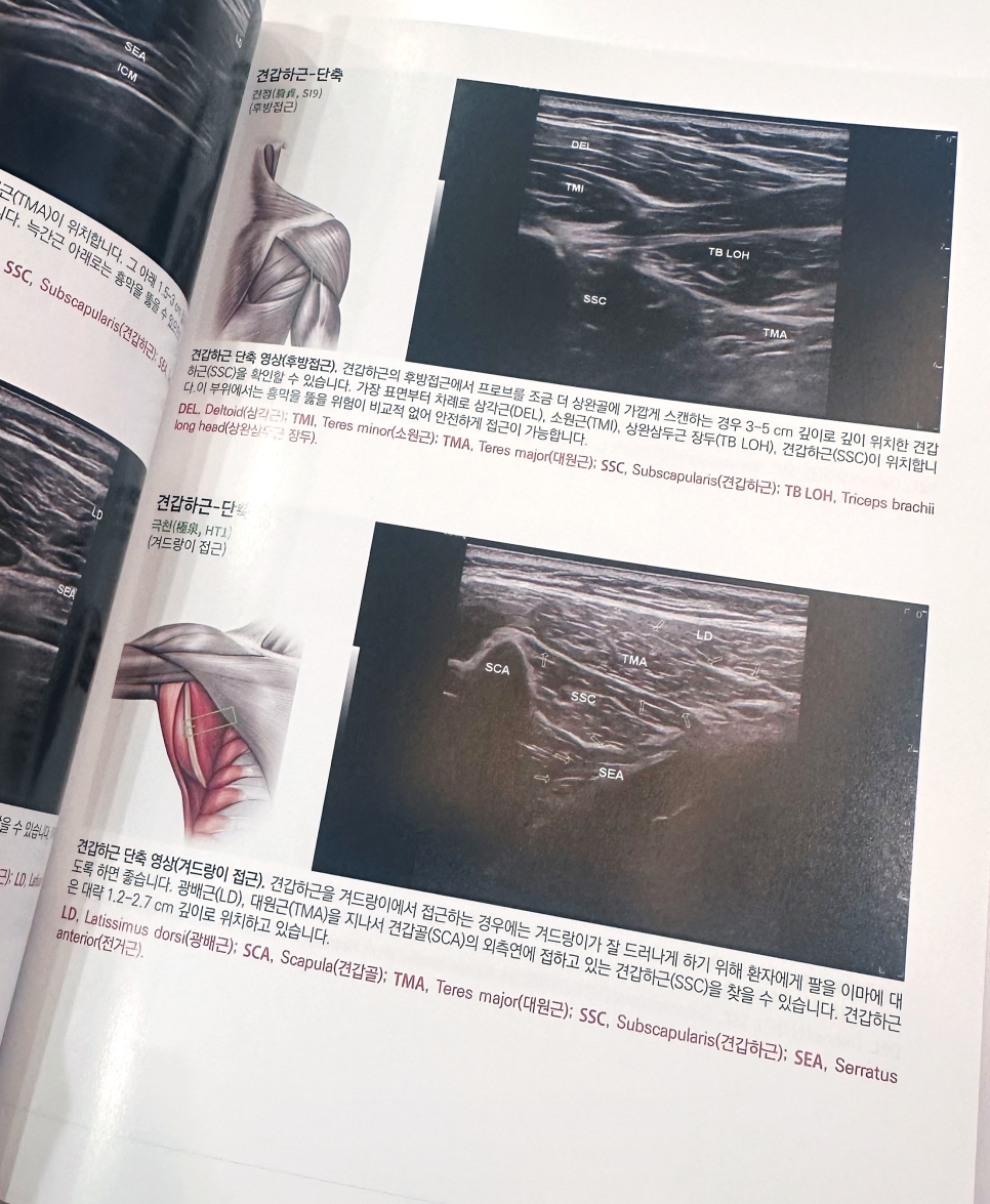 견갑하근의 후방 및 겨드랑이 접근법을 보여주는 해부학 그림과 초음파 영상이 있는 의학 서적 페이지 — 초음파 정밀 진단 | 서울 바로한의원 초음파 약침·도침·침도