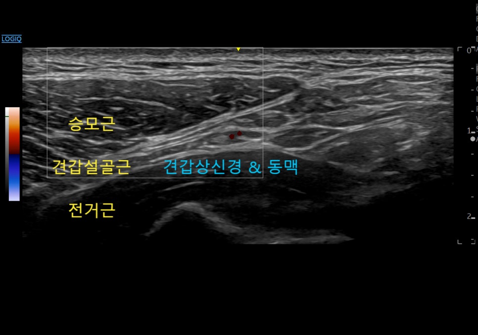 어깨 부위의 승모근, 견갑설골근, 전거근과 견갑상신경 및 동맥을 보여주는 초음파 영상 — 초음파 정밀 진단 | 서울 바로한의원 초음파 약침·도침·침도