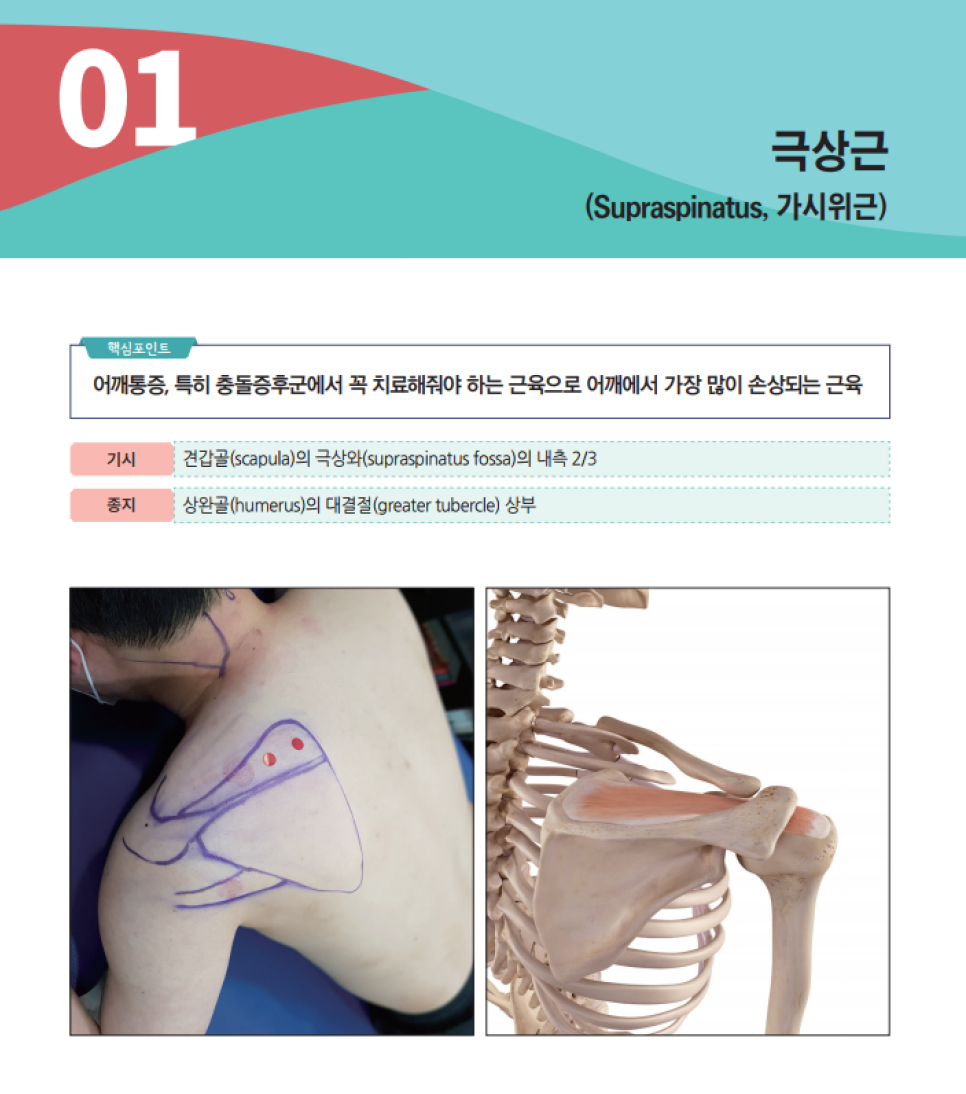 극상근의 해부학적 위치와 기시, 종지 정보가 있는 이미지로, 실제 어깨에 표시된 극상근 위치와 뼈대 모형에 표시된 극상근을 보여줍니다 — 서울 바로한의원 초음파 약침·도침
