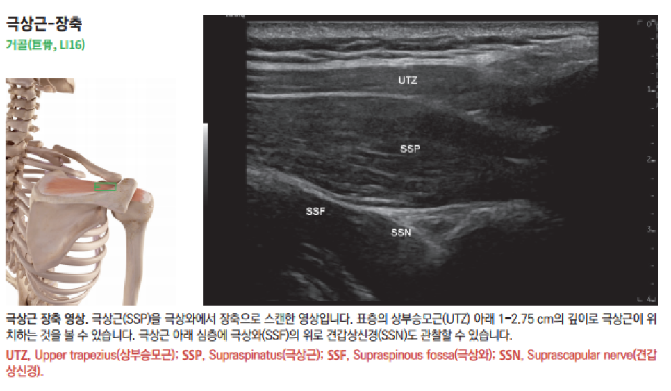 어깨 극상근의 해부학적 위치를 보여주는 골격 그림과 극상근, 상부승모근, 극상와, 견갑상신경을 표시한 어깨 초음파 영상 — 초음파 정밀 진단 | 서울 바로한의원 초음파 약침·도침·침도