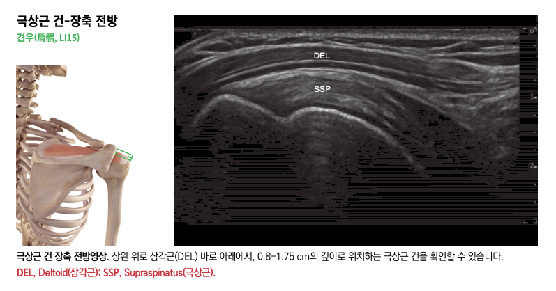 어깨의 극상근 해부학적 그림과 극상근 건 및 삼각근이 보이는 어깨 초음파 영상 — 초음파 정밀 진단 | 서울 바로한의원 초음파 약침·도침·침도