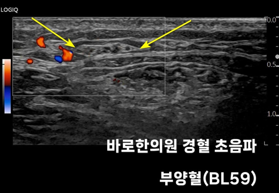 노란색 화살표가 혈류와 주변 조직을 가리키는 부양혈(BL59) 부위의 초음파 사진 — 초음파 정밀 진단 | 서울 바로한의원 초음파 약침·도침·침도