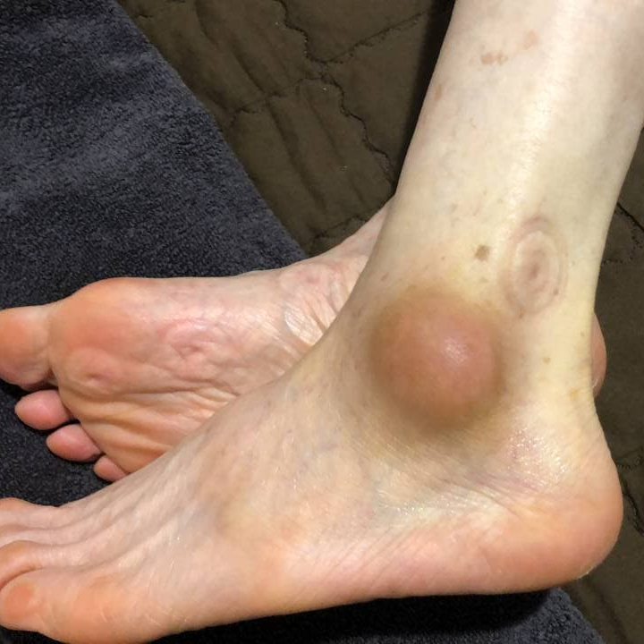 발목 바깥쪽에 붉게 부어오른 혹이 있는 모습 — 서울 바로한의원 초음파 약침·도침