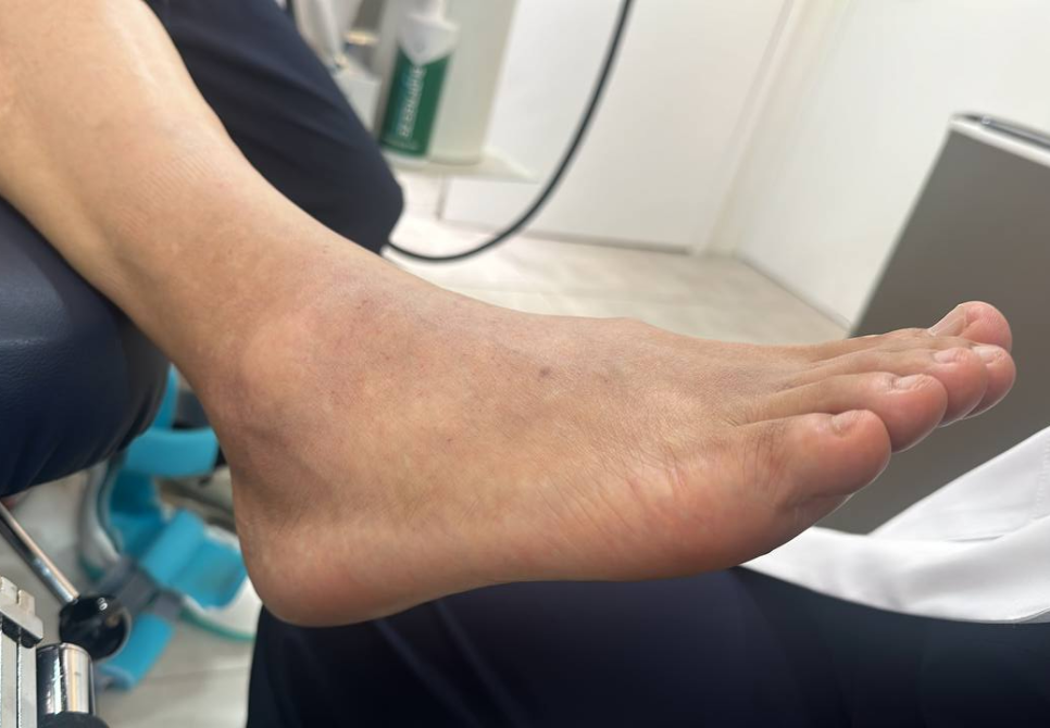 발목과 발이 부어 있고 피부에 변색이 있는 모습 — 서울 바로한의원 초음파 약침·도침