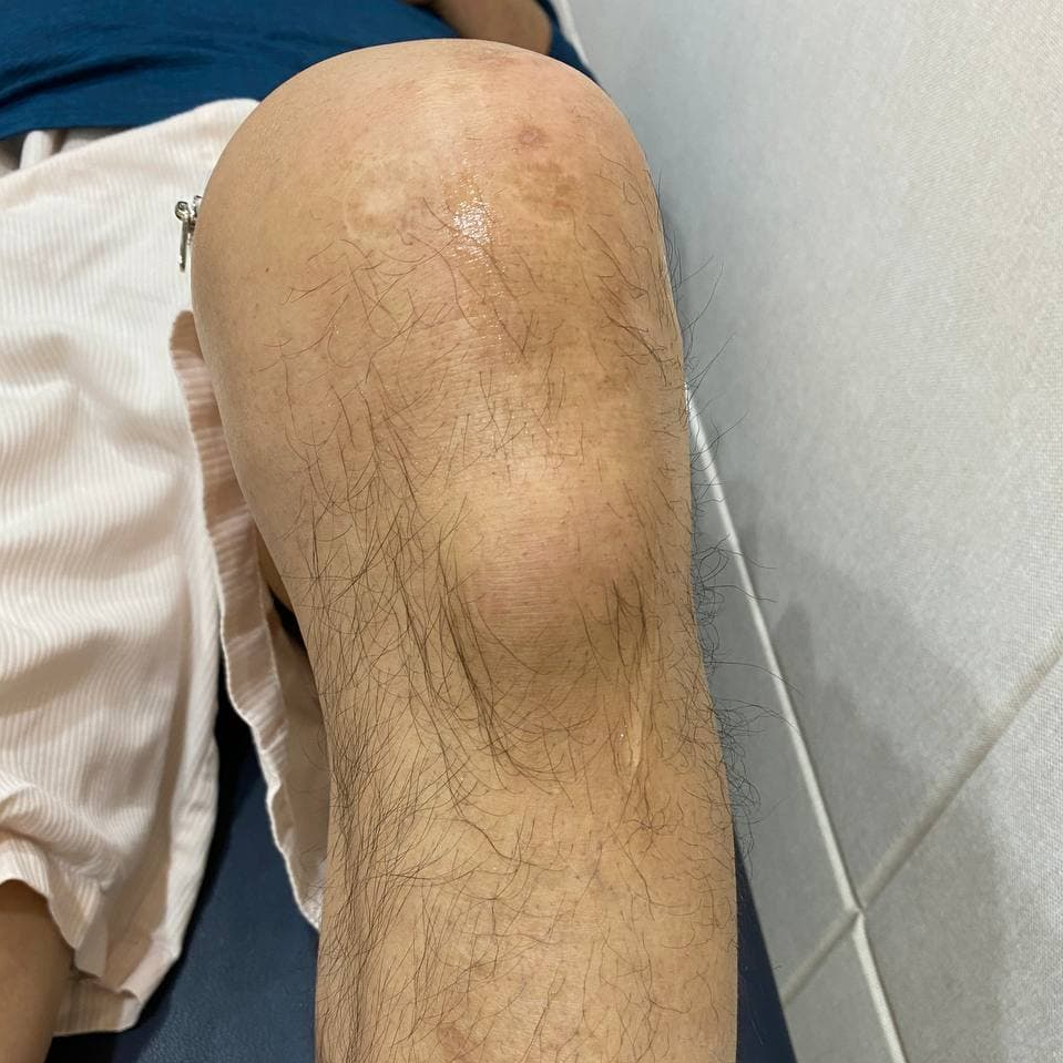 털이 있는 무릎에 부기가 있는 모습 — 서울 바로한의원 초음파 약침·도침
