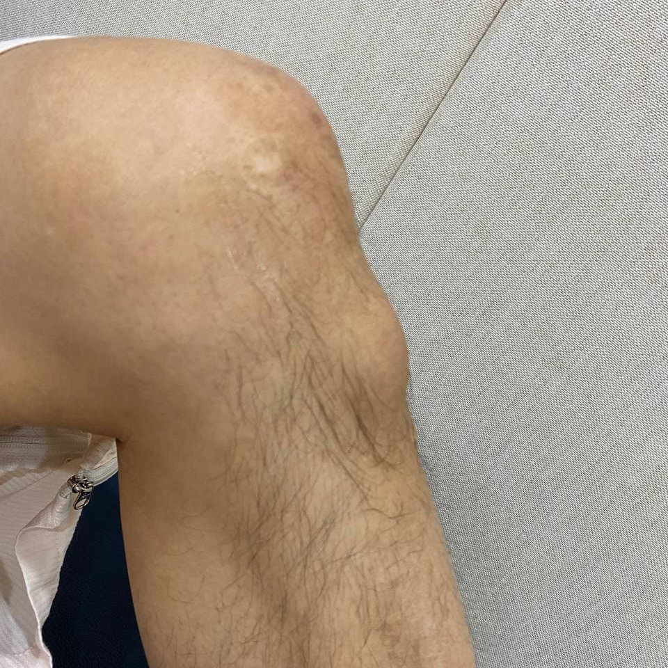 무릎 앞쪽에 부기가 있는 다리 사진 — 서울 바로한의원 초음파 약침·도침